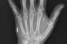 Röntgenbild på hand med inopererade mikrochip. Foto. 
